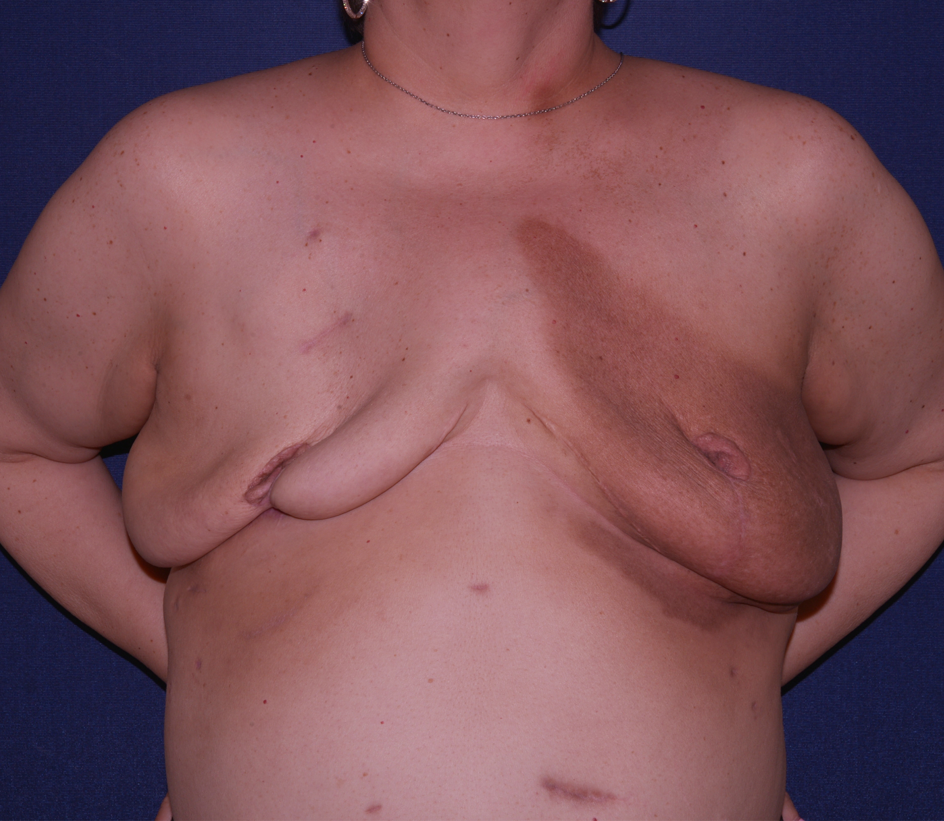Breast Reconstruction Before & After | Dr. Becker