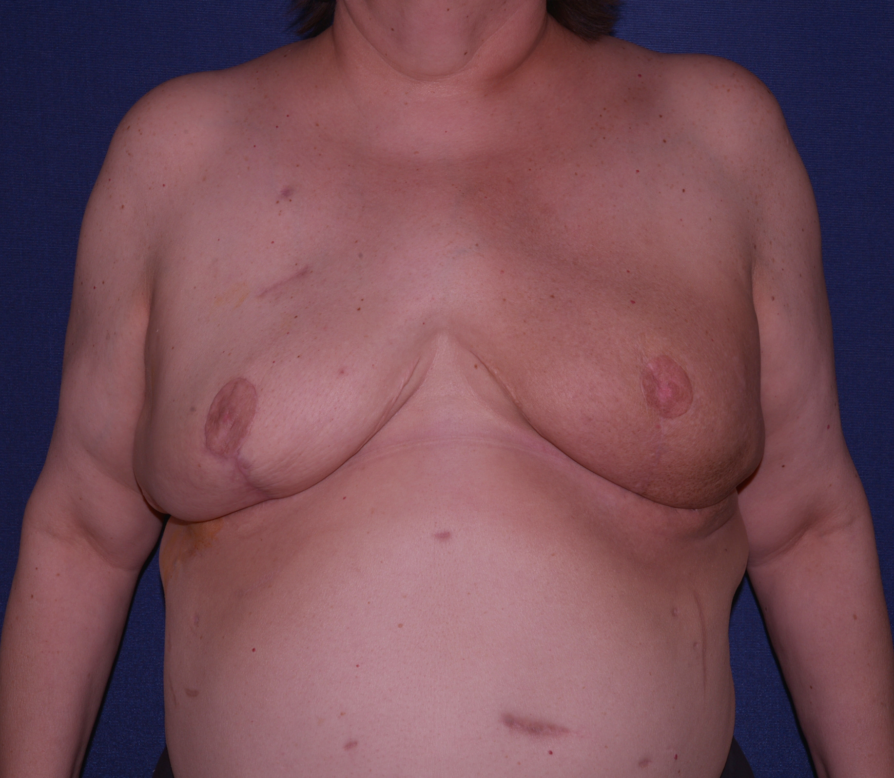 Breast Reconstruction Before & After | Dr. Becker