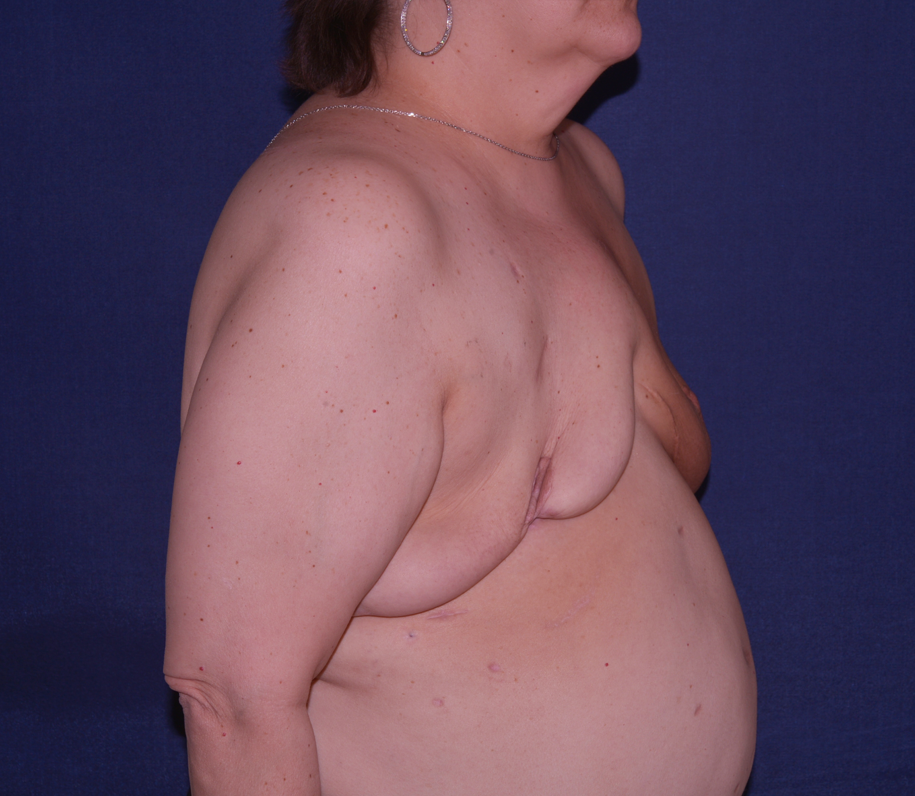 Breast Reconstruction Before & After | Dr. Becker