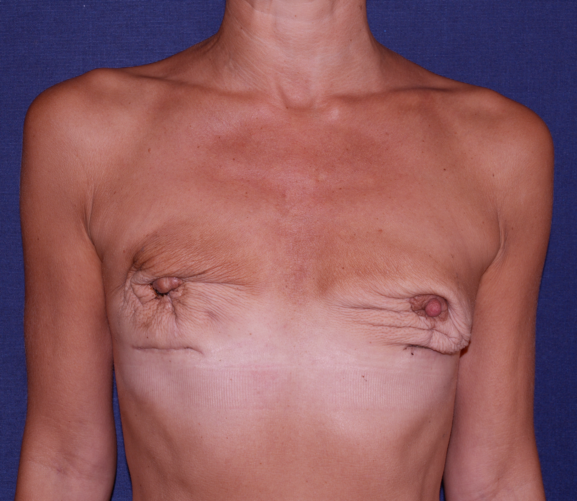Breast Reconstruction Before & After | Dr. Becker
