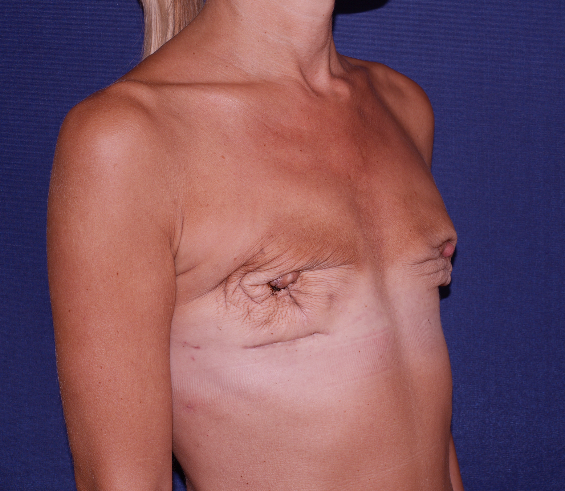 Breast Reconstruction Before & After | Dr. Becker