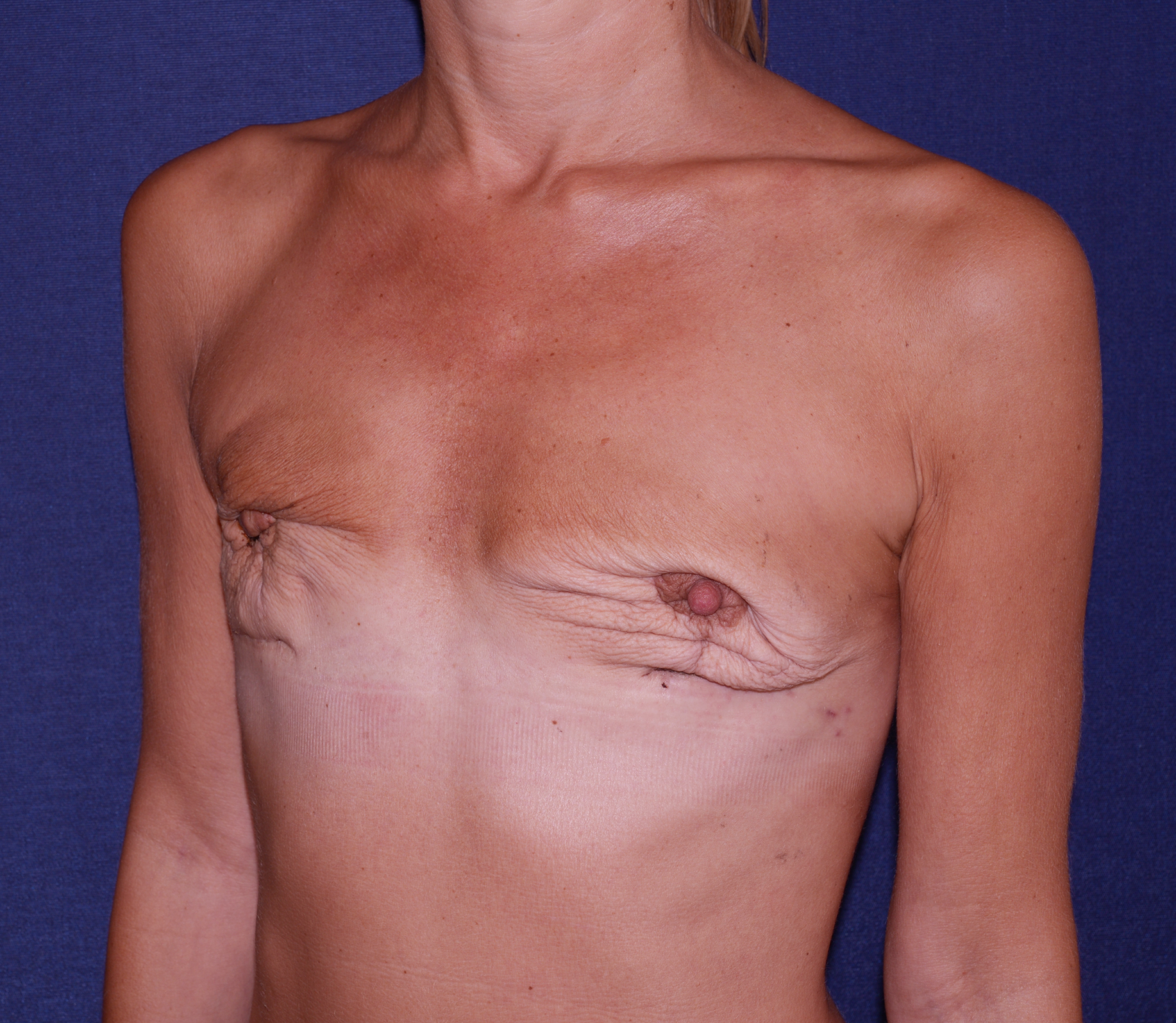 Breast Reconstruction Before & After | Dr. Becker