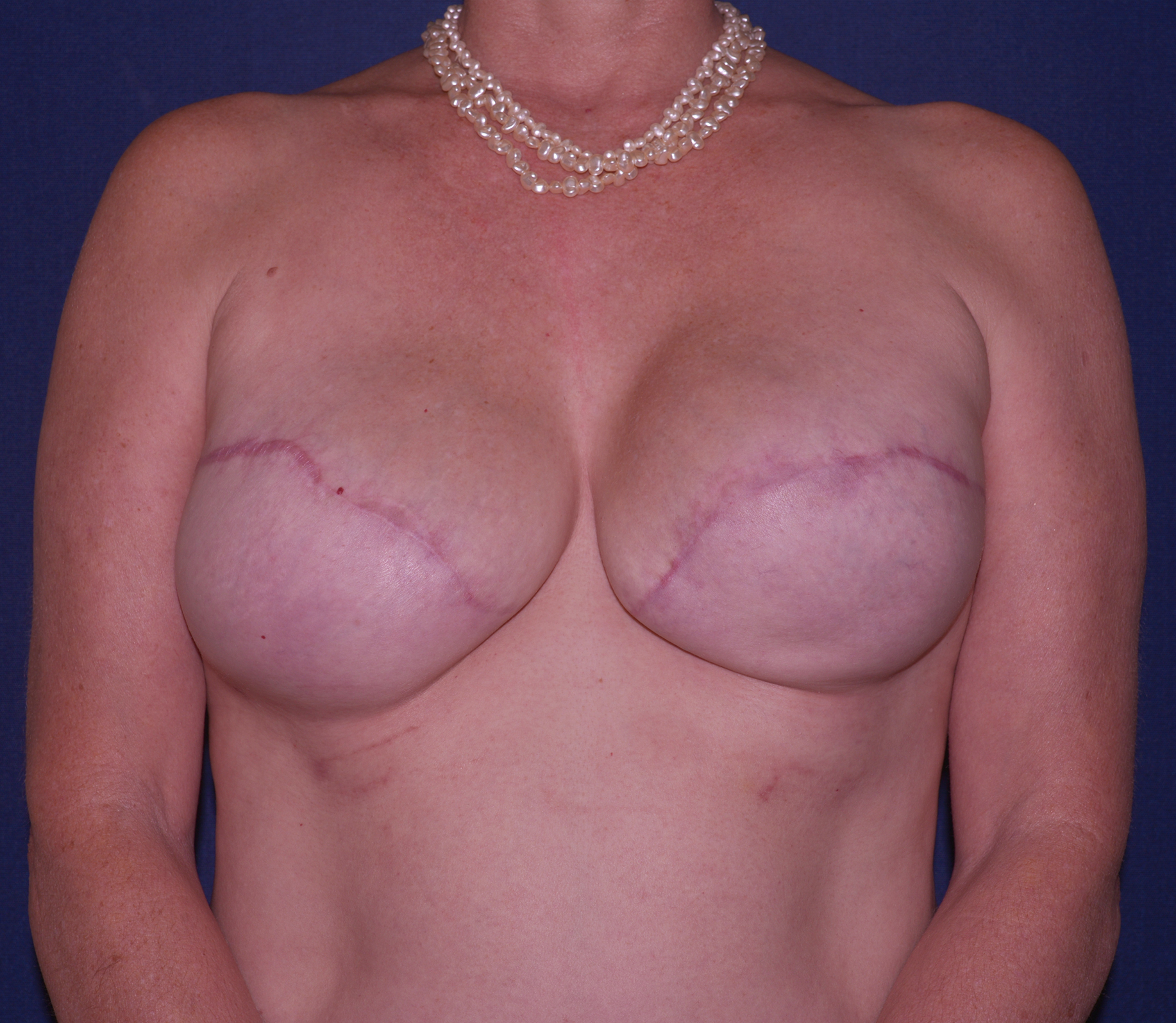 Breast Reconstruction Before & After | Dr. Becker