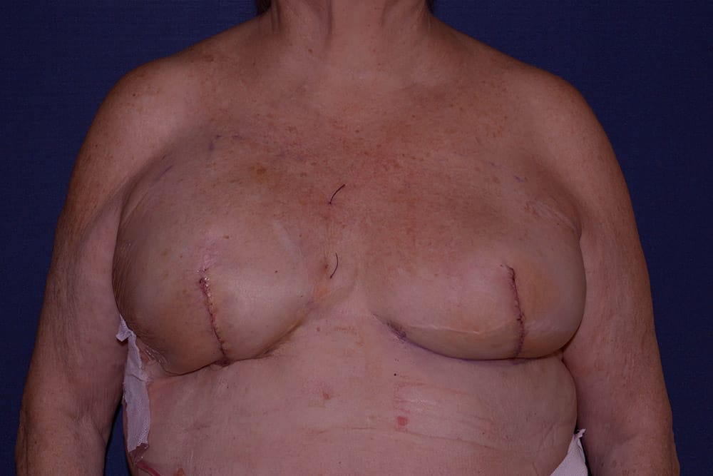 Breast Reconstruction Before & After | Dr. Becker