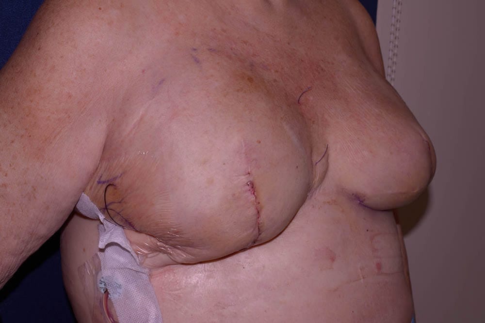 Breast Reconstruction Before & After | Dr. Becker