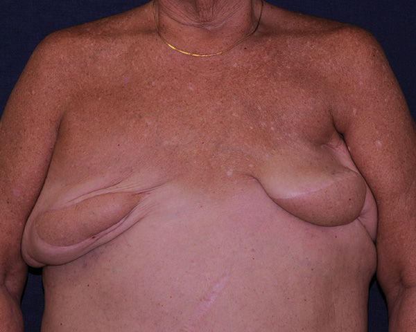 Breast Reconstruction Before & After | Dr. Becker