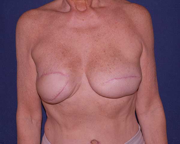 Breast Reconstruction Before & After | Dr. Becker