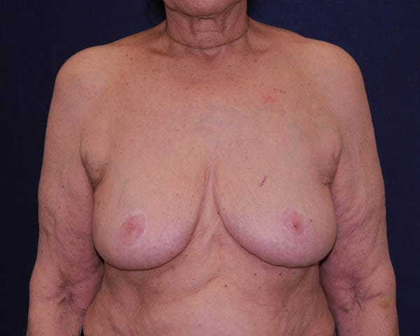 Breast Reduction Before & After | Dr. Becker