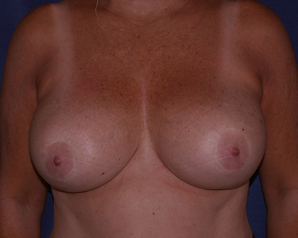Breast Reduction Before & After | Dr. Becker
