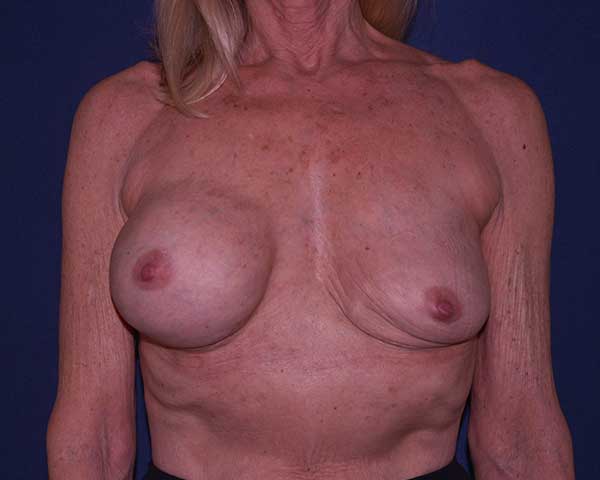 Correction Of Breast Implant Complications Animation Deformity Before & After | Dr. Becker