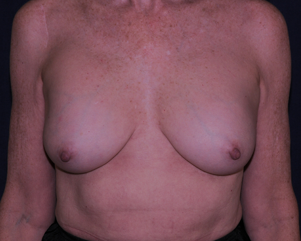 Correction Of Breast Implant Complications Before & After | Dr. Becker