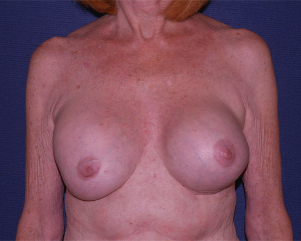 Correction Of Breast Implants Before & After | Dr. Becker