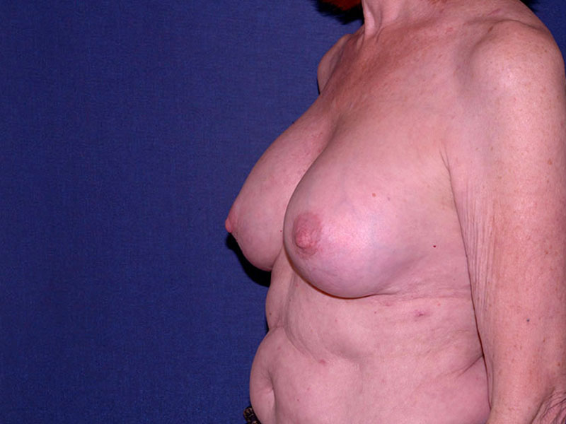Correction Of Breast Implants Before & After | Dr. Becker