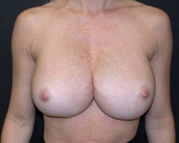 Correction Of Breast Implants Before & After | Dr. Becker