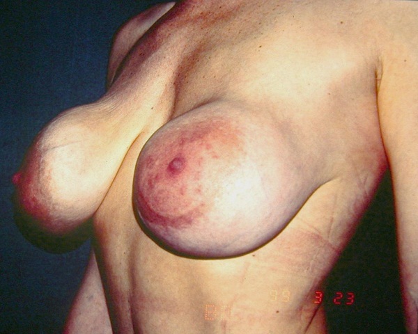 Correction Of Breast Implants Before & After | Dr. Becker