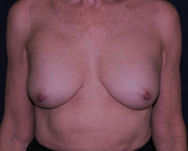 Correction Of Breast Implants Before & After | Dr. Becker