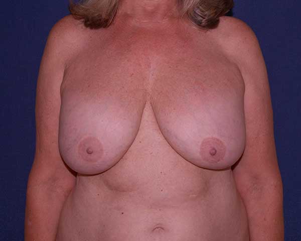 Correction Of Breast Implants Before & After | Dr. Becker