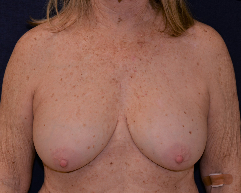 Implant Removal Restoration Before & After | Dr. Becker