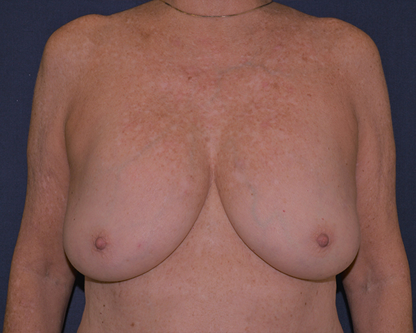 Implant Removal Restoration Before & After | Dr. Becker