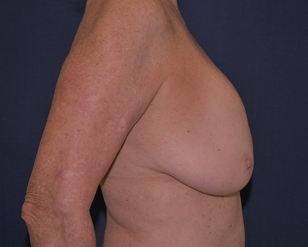 Implant Removal Restoration Before & After | Dr. Becker