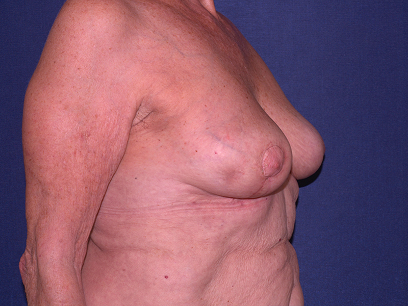 Implant Removal Restoration Before & After | Dr. Becker