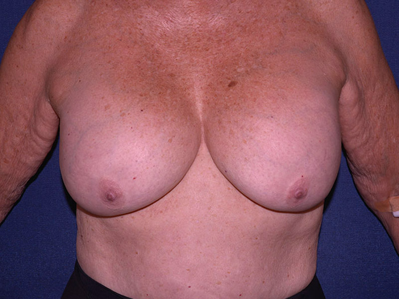 Implant Removal Restoration Before & After | Dr. Becker