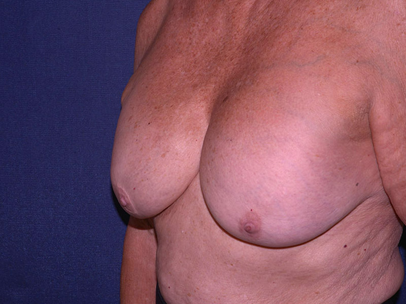 Implant Removal Restoration Before & After | Dr. Becker