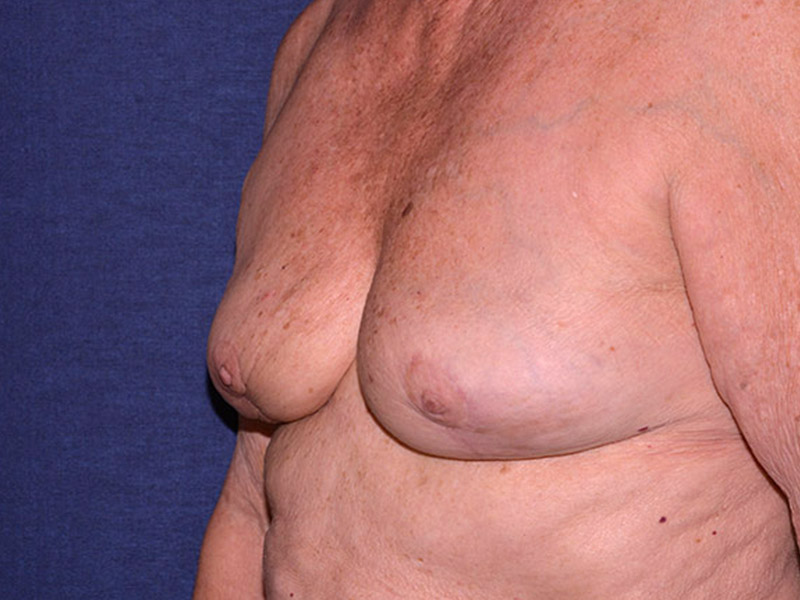 Implant Removal Restoration Before & After | Dr. Becker
