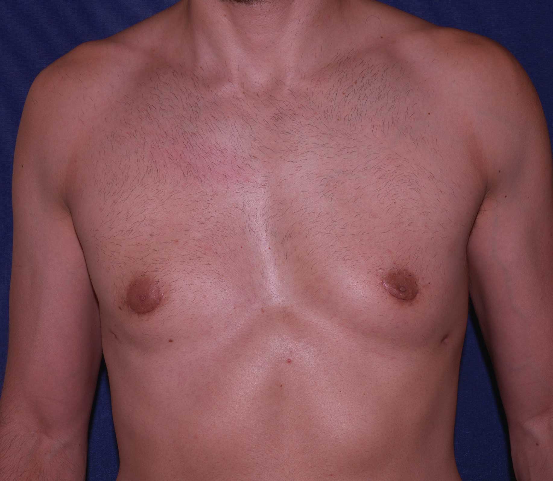 Male Breast Reduction Before & After | Dr. Becker