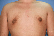 Male Breast Reduction Before & After | Dr. Becker