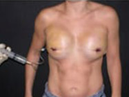 Prophylactic Mastectomy Before & After | Dr. Becker
