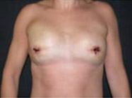 Prophylactic Mastectomy Before & After | Dr. Becker