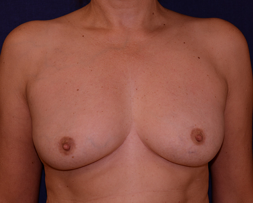 With Fat Grafting Before & After | Dr. Becker