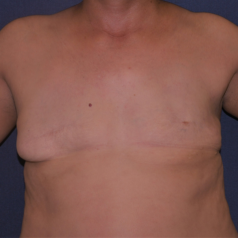 With Fat Grafting Before & After | Dr. Becker