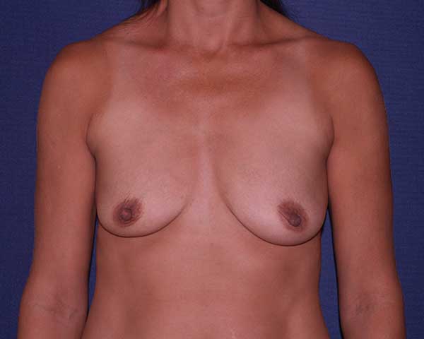 With Implants Before & After | Dr. Becker