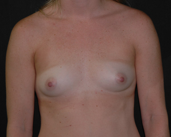 With Implants Before & After | Dr. Becker