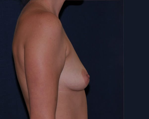 With Implants Before & After | Dr. Becker
