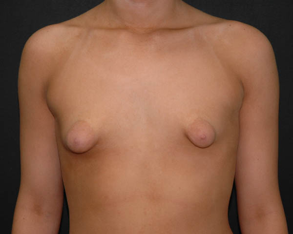 With Implants Before & After | Dr. Becker