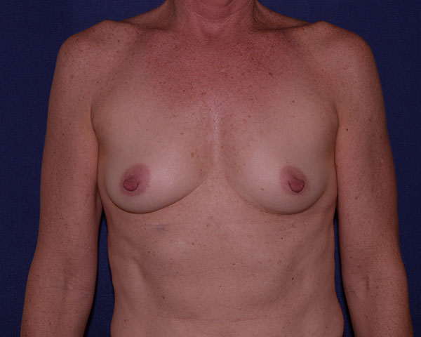 With Implants Before & After | Dr. Becker