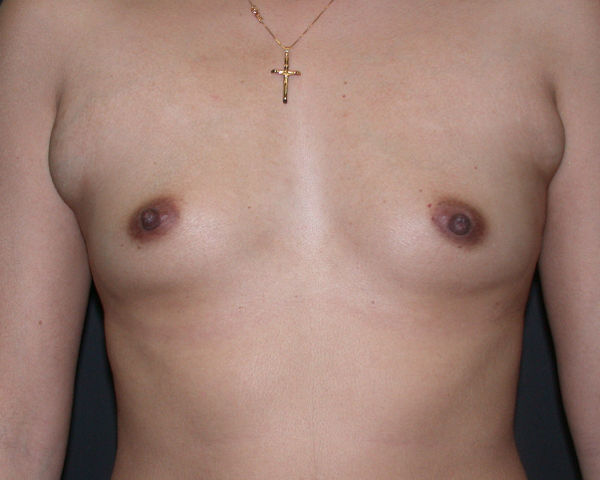 With Implants Before & After | Dr. Becker