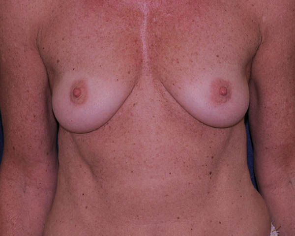 With Implants Before & After | Dr. Becker