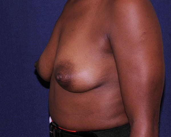 With Implants Before & After | Dr. Becker