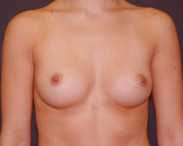 With Implants Before & After | Dr. Becker