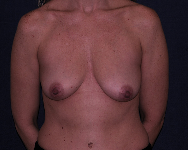 With Implants Before & After | Dr. Becker