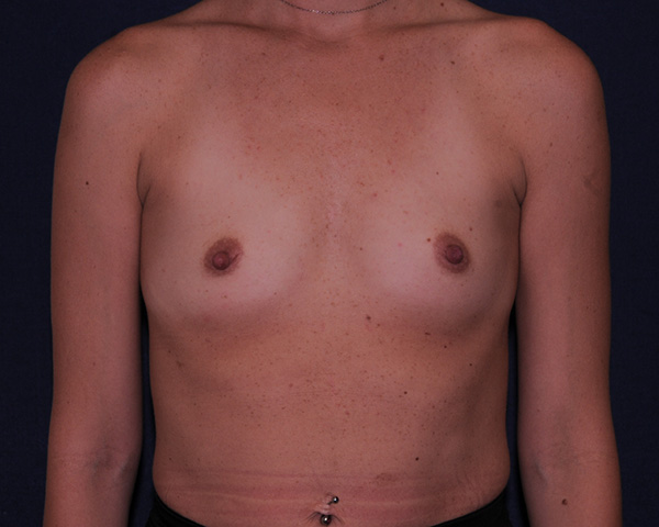 With Implants Before & After | Dr. Becker