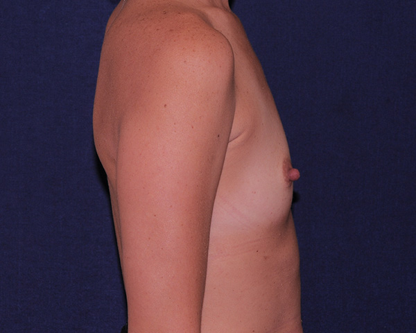 With Implants Before & After | Dr. Becker