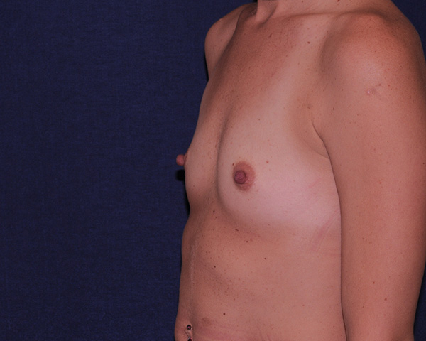 With Implants Before & After | Dr. Becker