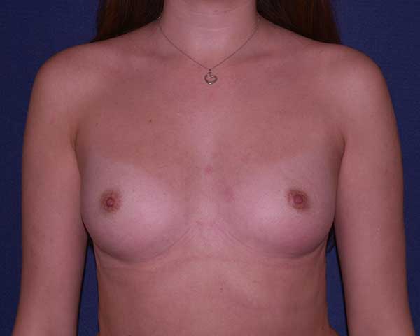 With Implants Before & After | Dr. Becker