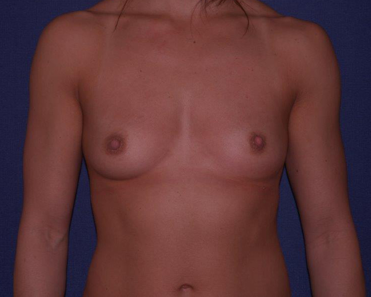 With Implants Before & After | Dr. Becker