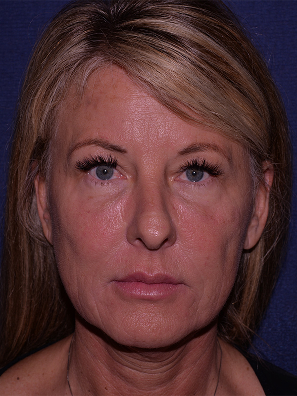 Fat Transfer (non Surgical Face Lift) Before & After | Dr. Becker